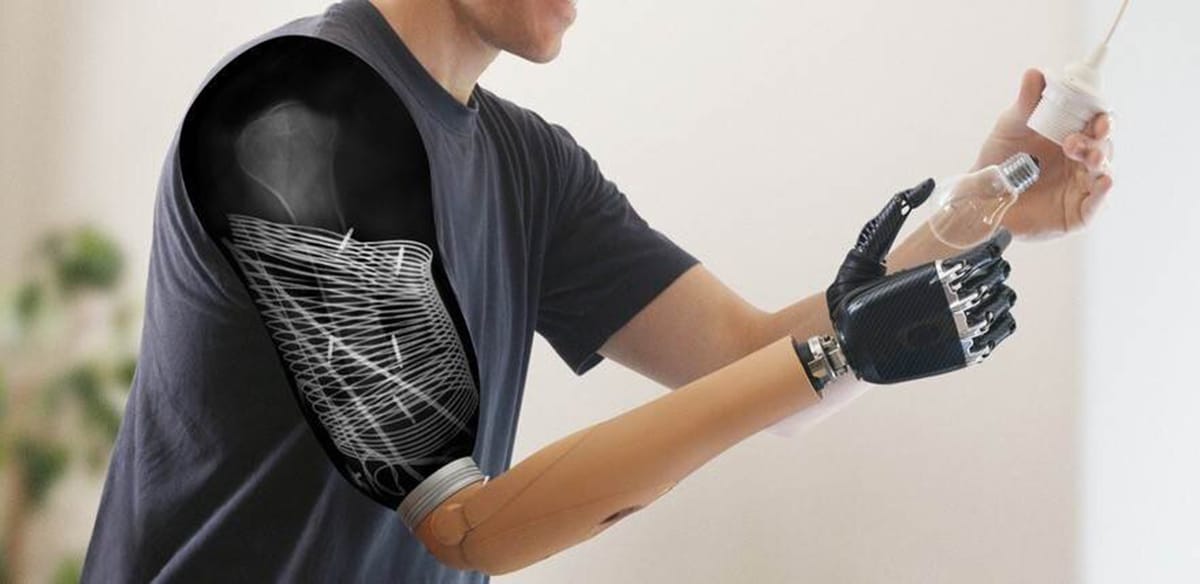 Prosthetics: for the first time, sensors have been implanted for wireless control of muscle signal transmission following nerve transfers