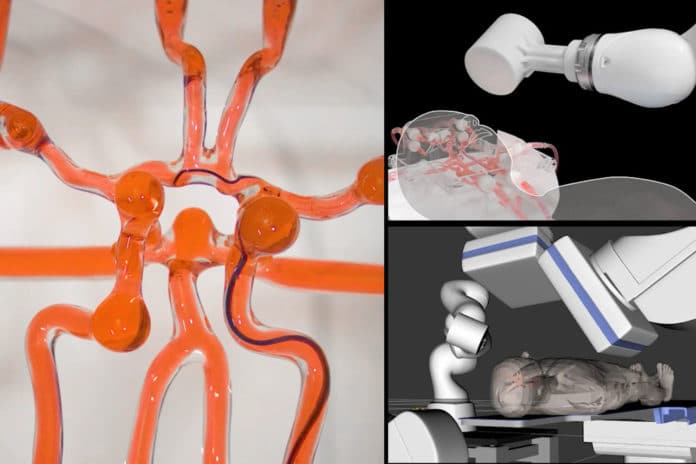 Caption:MIT engineers developed a telerobotic system to help surgeons remotely treat patients experiencing stroke or aneurysm.