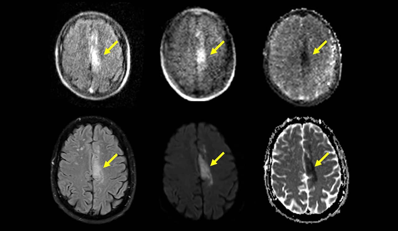 Portable MRI (top row) can detect and characterize ischemic stroke identified by standard MRI (bottom row), Yale researchers find.